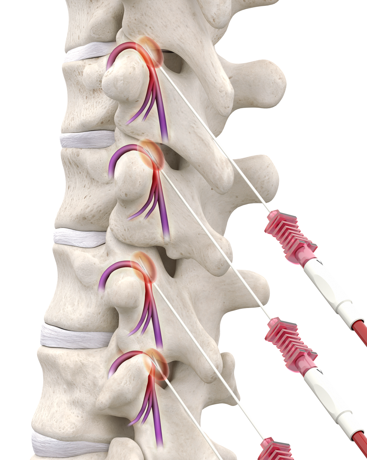 Radiofrequency Ablation Interventional Spine