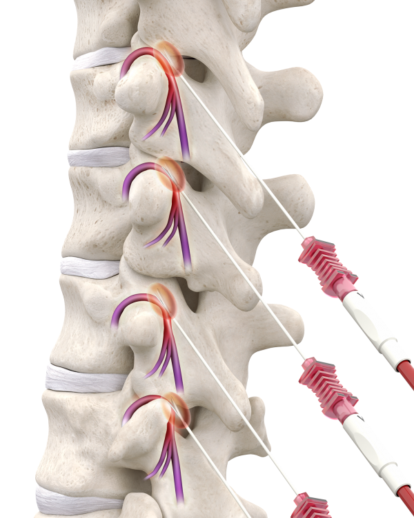 Radiofrequency Ablation | Interventional Spine