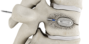 Balloon kyphoplasty  Interventional Spine