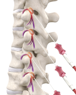 Radiofrequency ablation | Interventional Spine